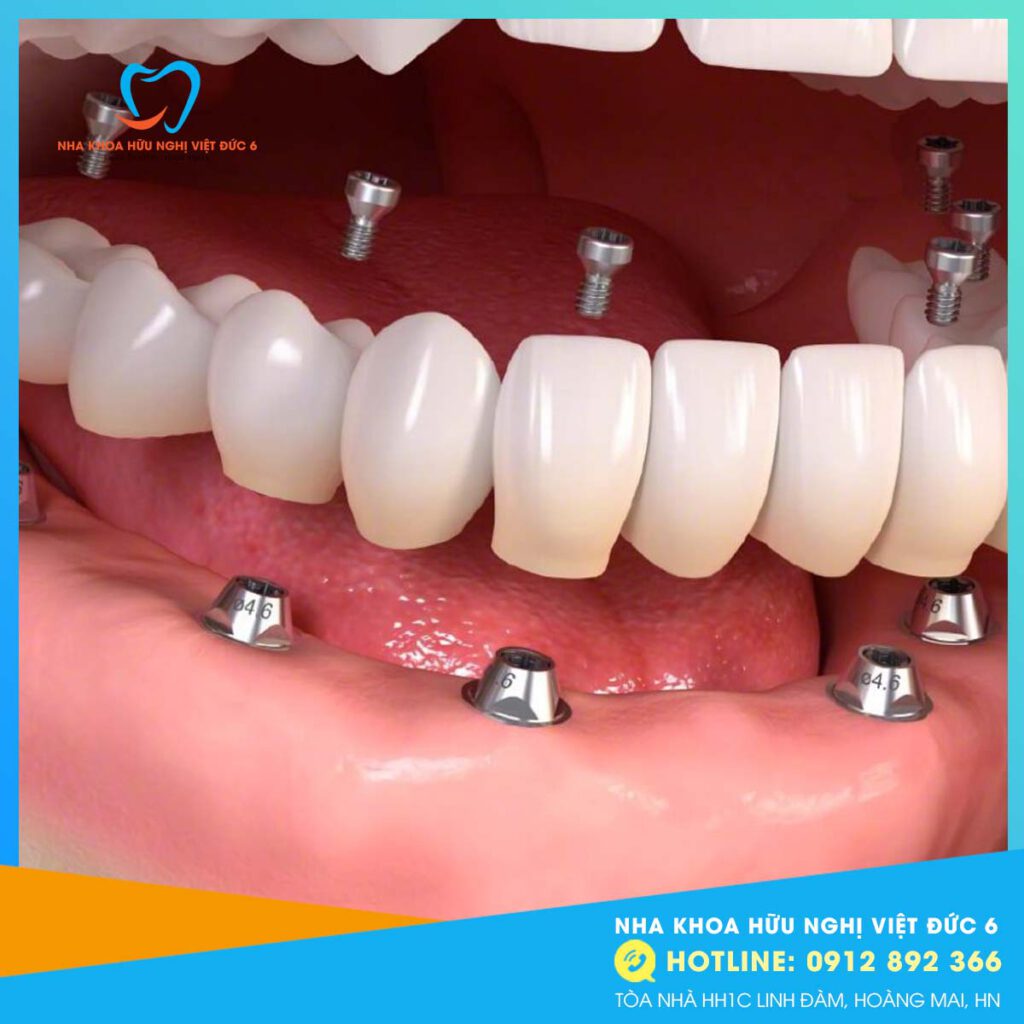 Cấy Ghép Implant Tức Thì