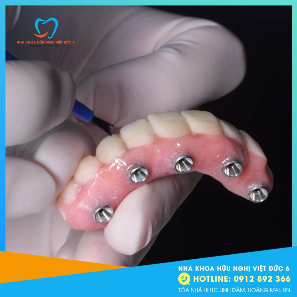 Cấy Ghép Implant All On 4.