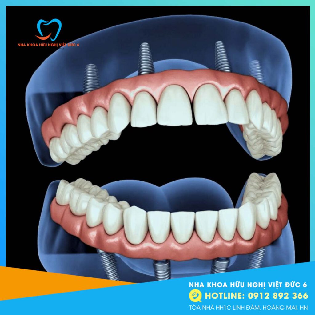 Cấy Ghép Implant All On 4..