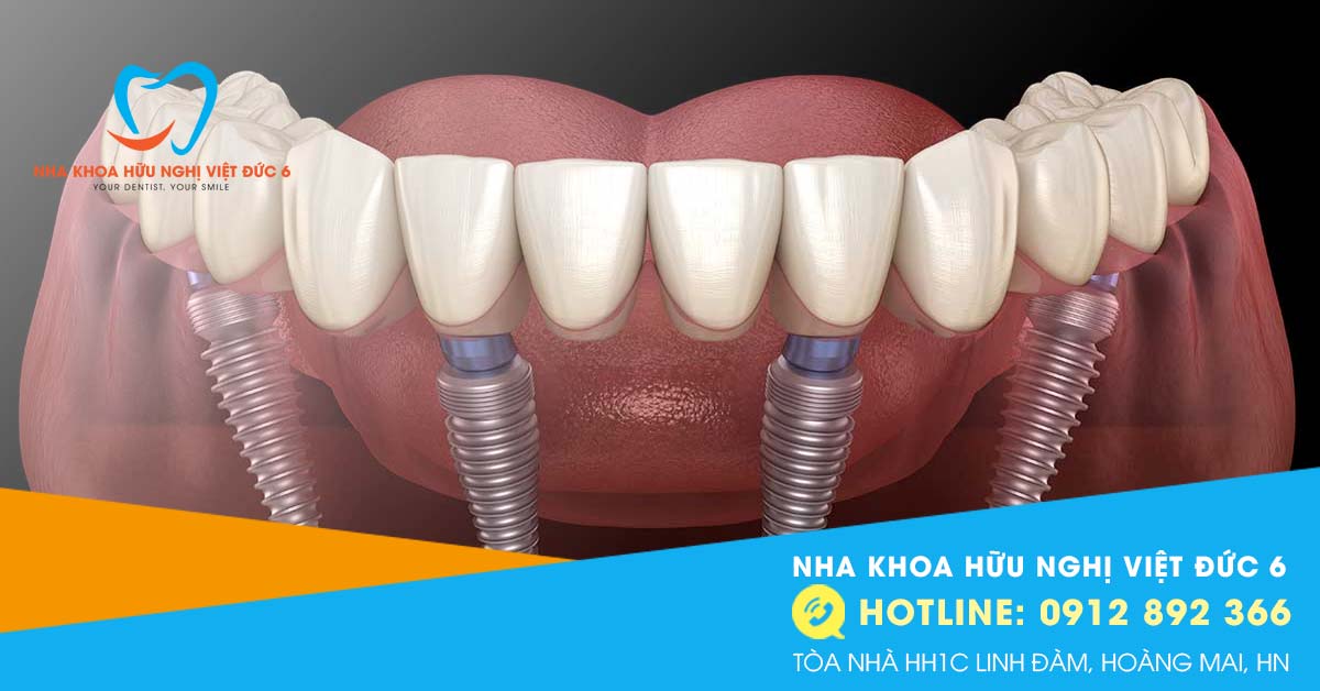 Cấy Ghép Implant All On 4