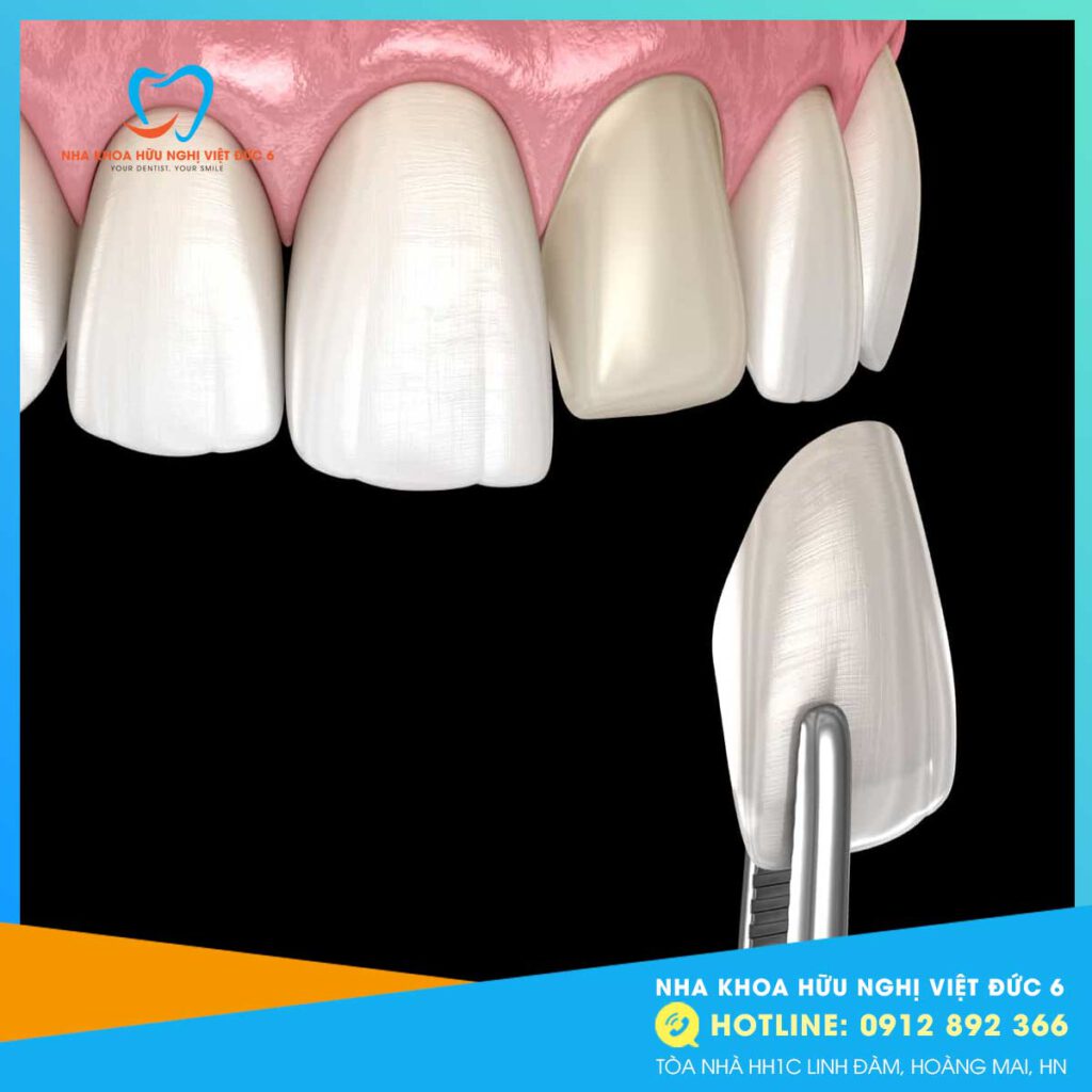 Mặt dán sứ Veneers