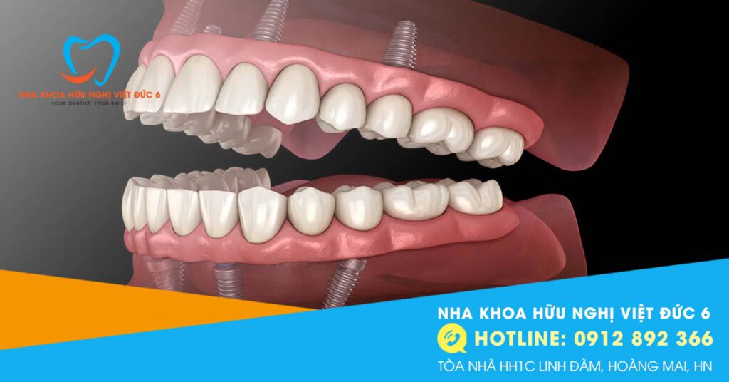 Hàm Giả Tháo Lắp Trên Implant