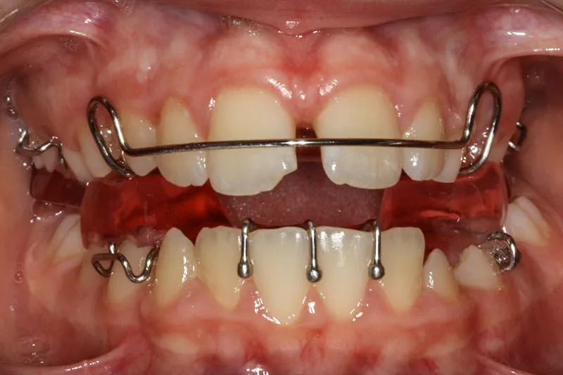 Images Smile Gallery Orthodontic Treatments Amanda 03