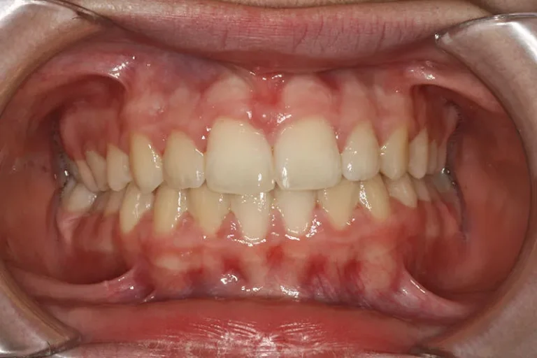 Images Smile Gallery Orthodontic Treatments Amanda 04 768x512