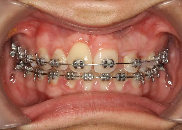 Images Smile Gallery Orthodontic Treatments Kate 03