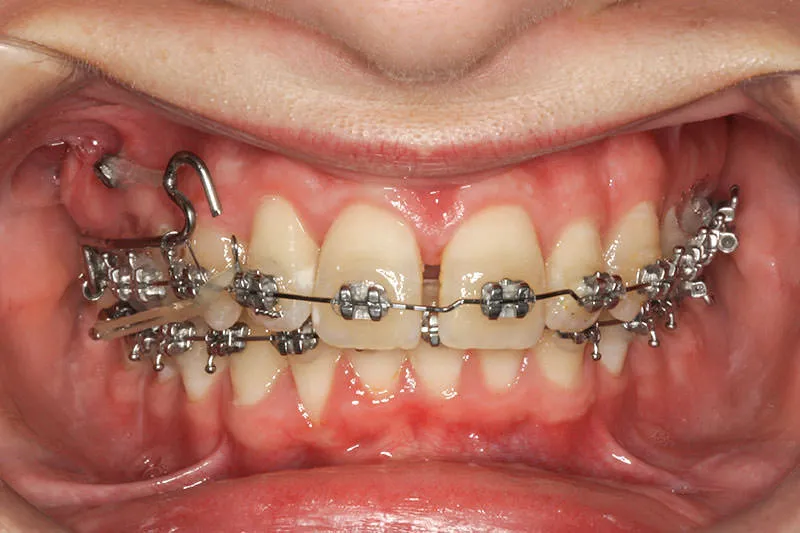 Images Smile Gallery Orthodontic Treatments Maria 03