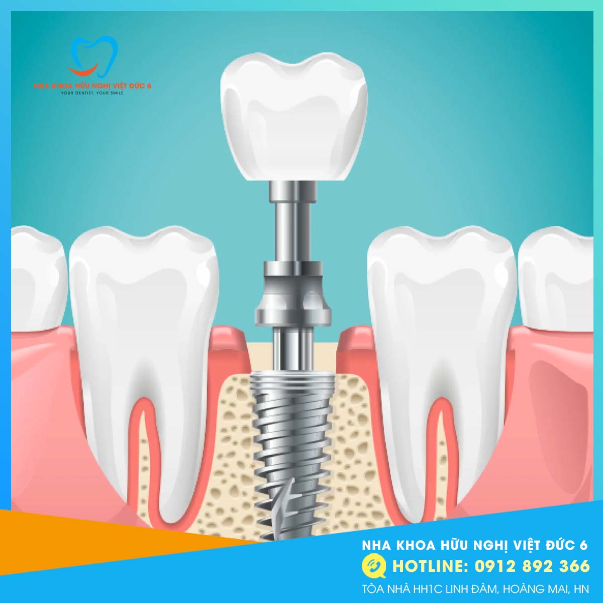 Cấy Ghép Implant Tức Thì