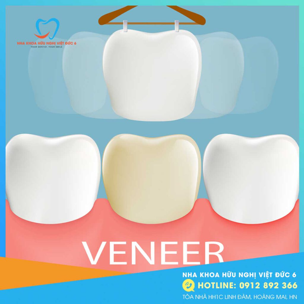 Dán Sứ Veneer