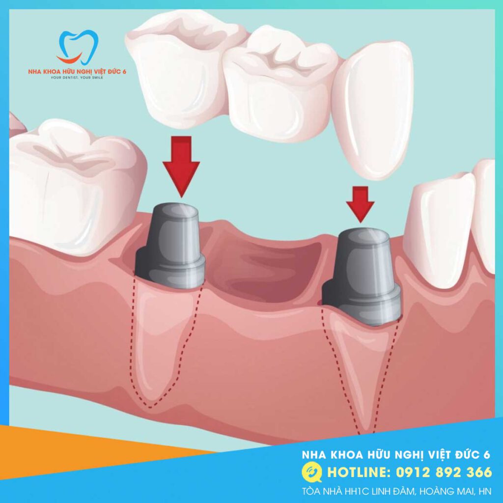 Trồng Răng Bắc Cầu