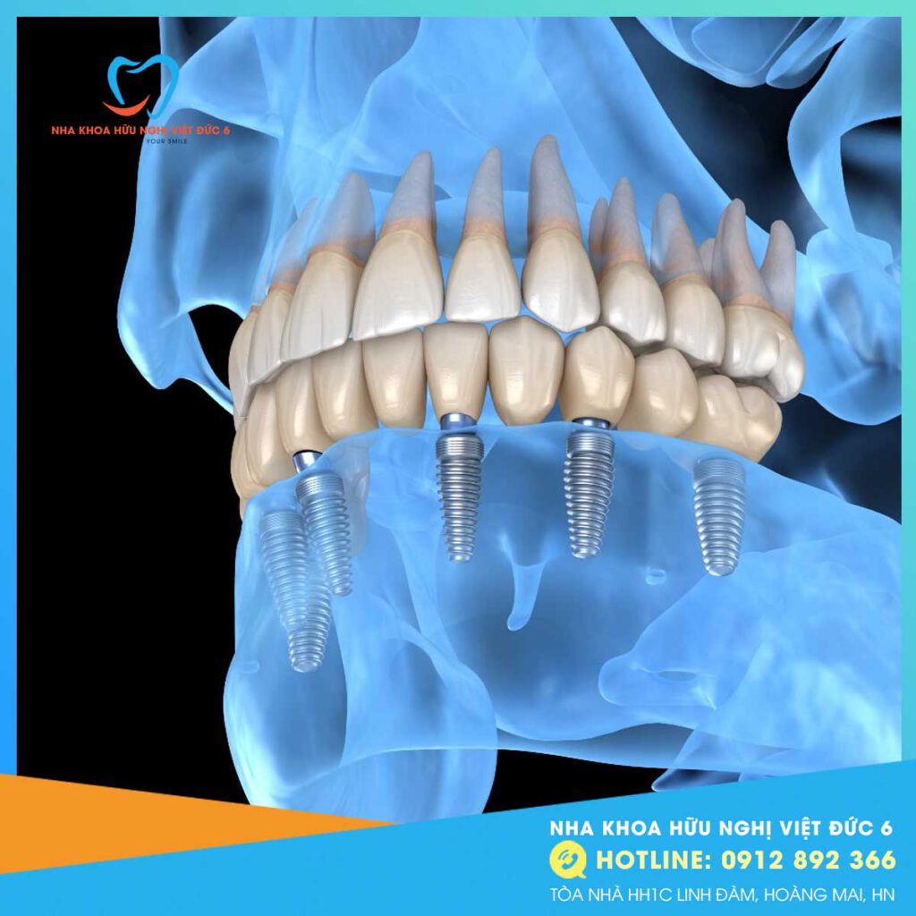 Trồng Răng Implant