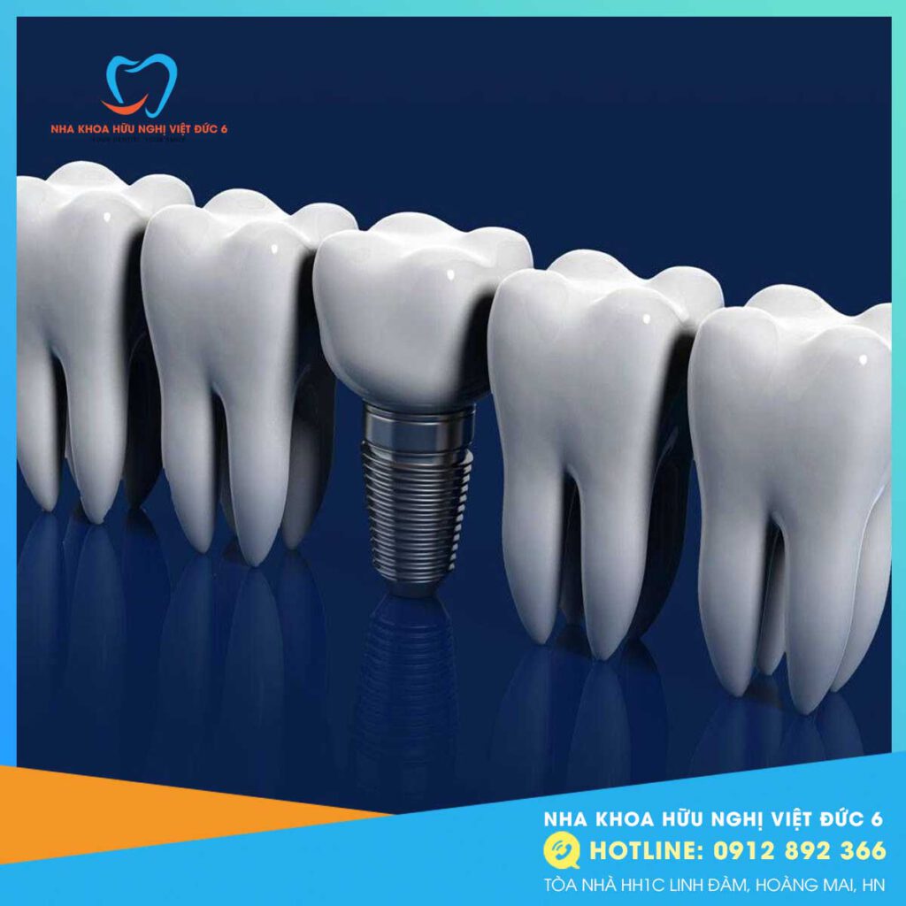 Trồng Răng Implant