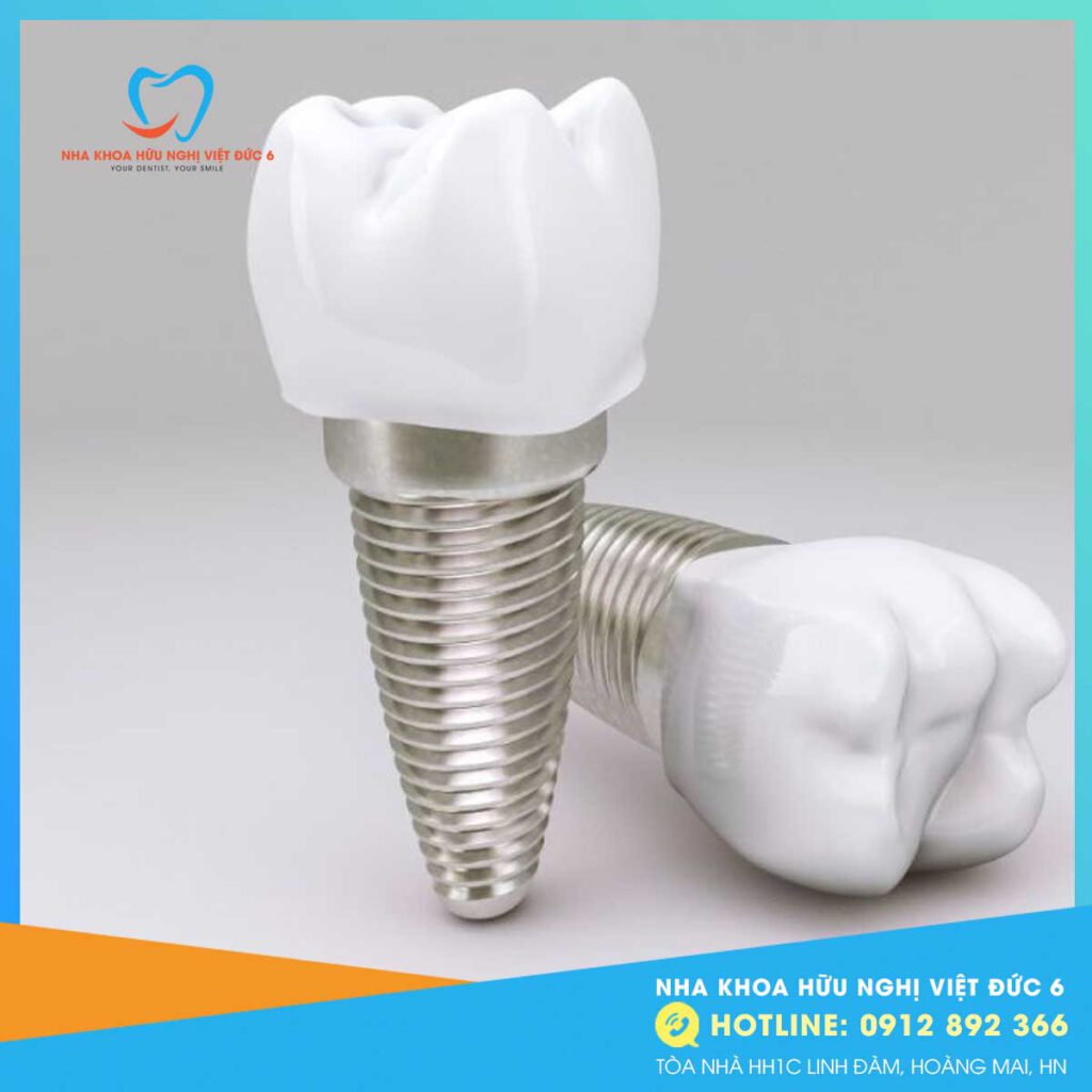 Trồng Răng Implant