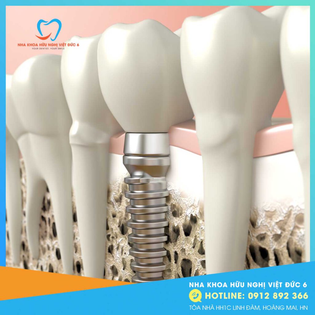 Trồng Răng Implant