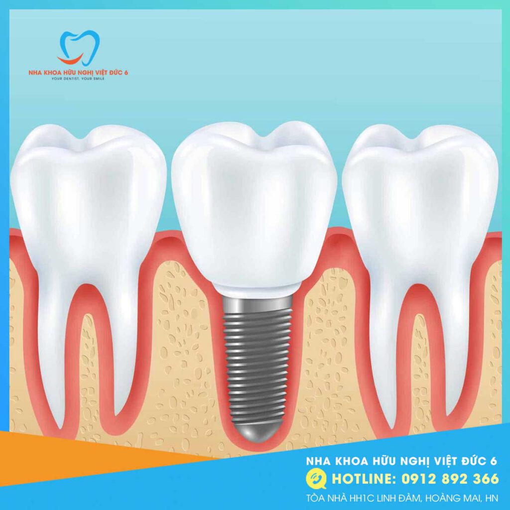 Trồng Răng Implant