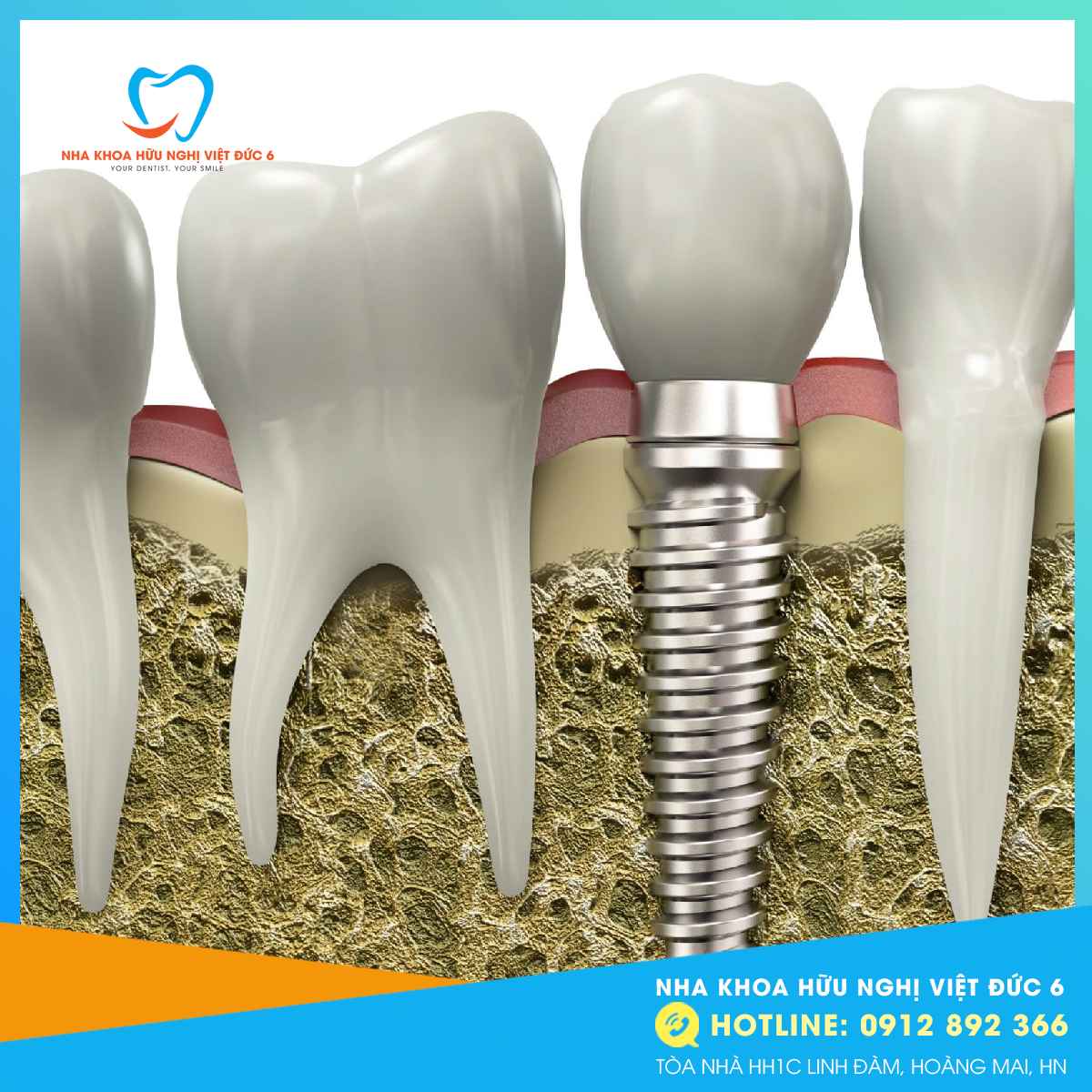 Trụ Implant (1)