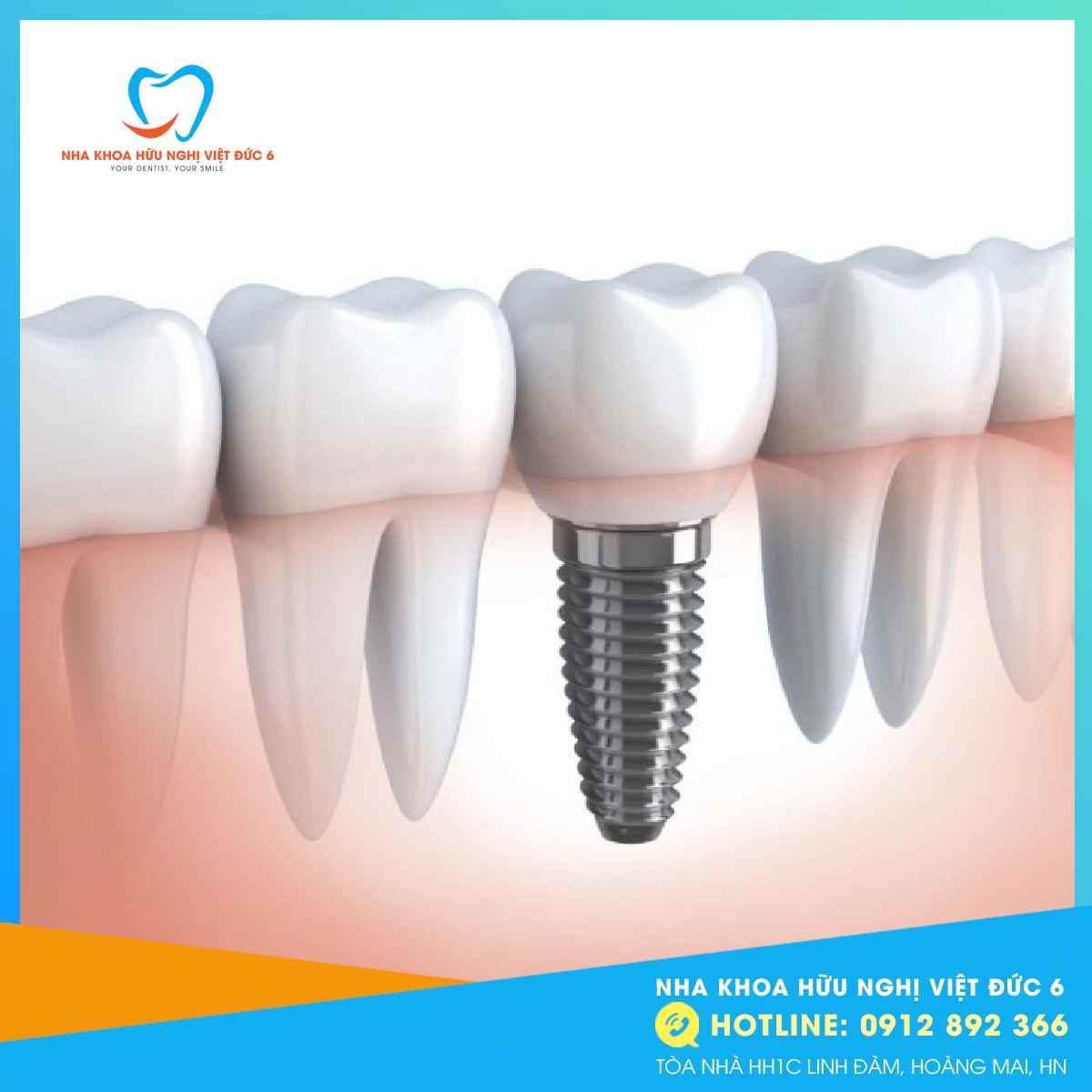 Trụ Implant 