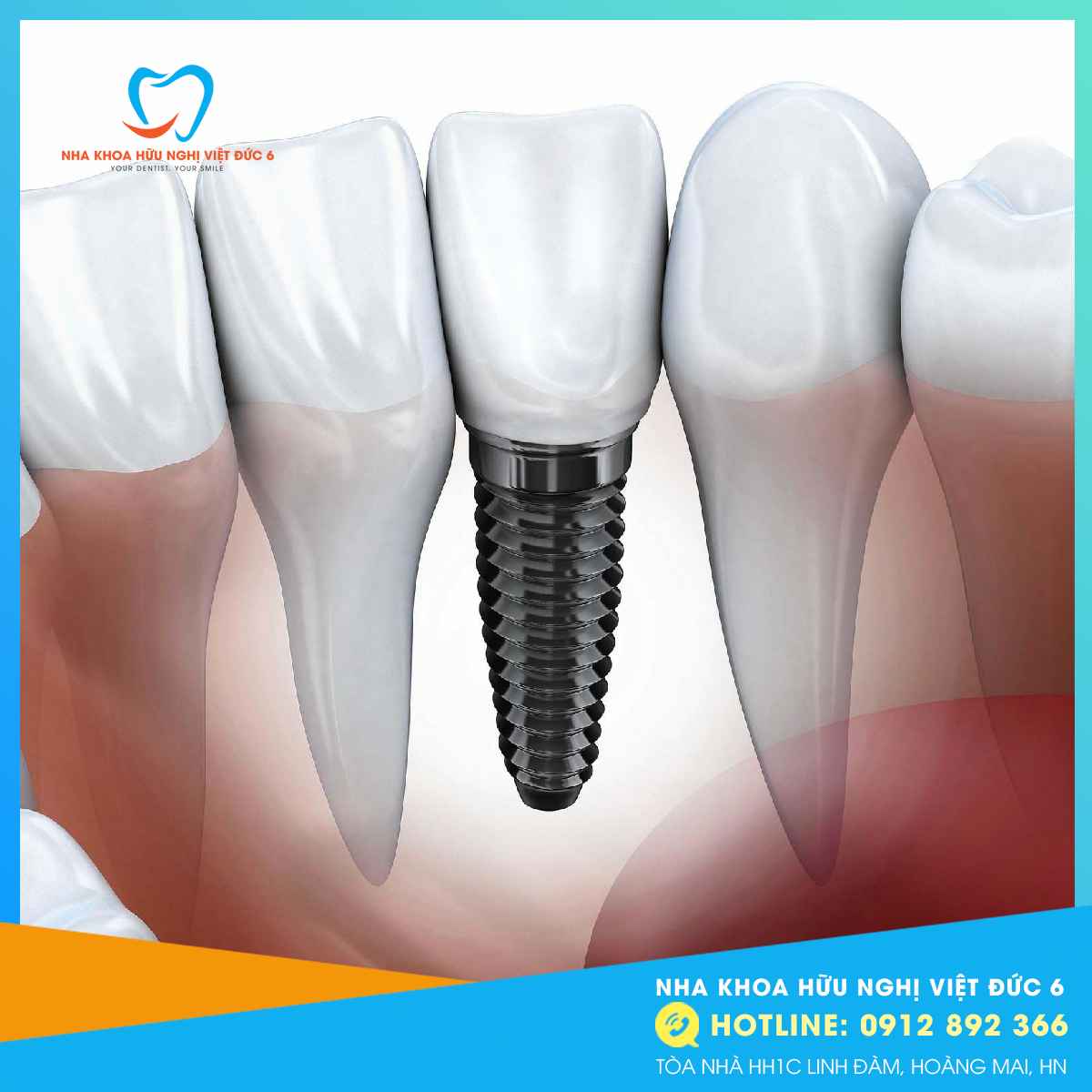 Trụ Implant (3)