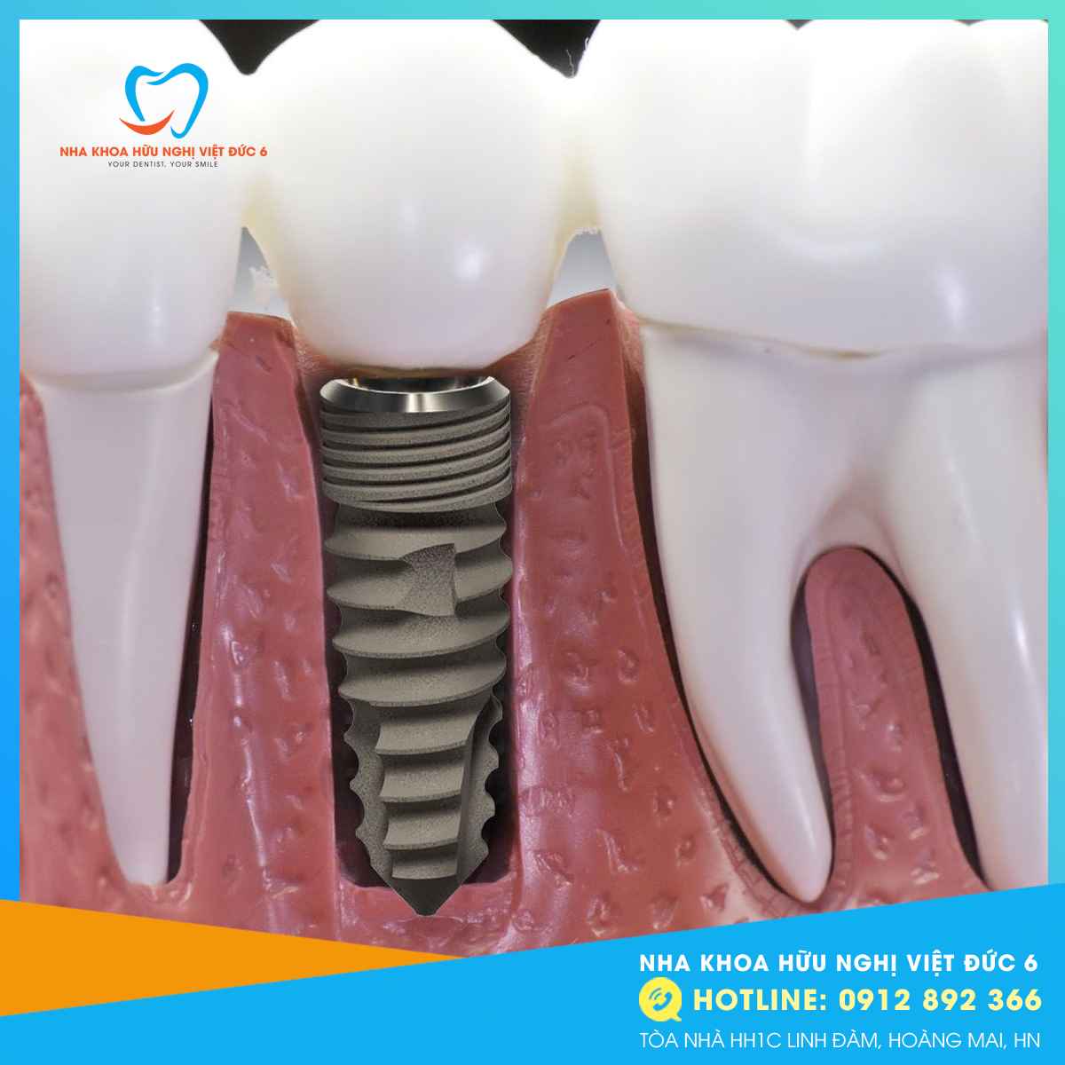 Trụ Implant