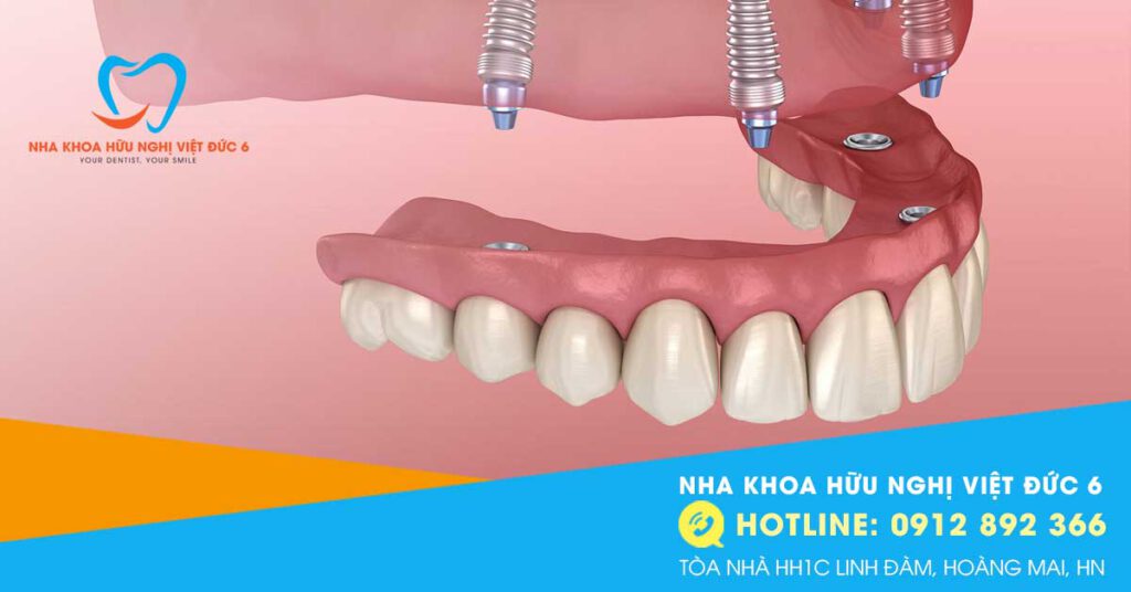 Trồng Răng Implant All On 4 L