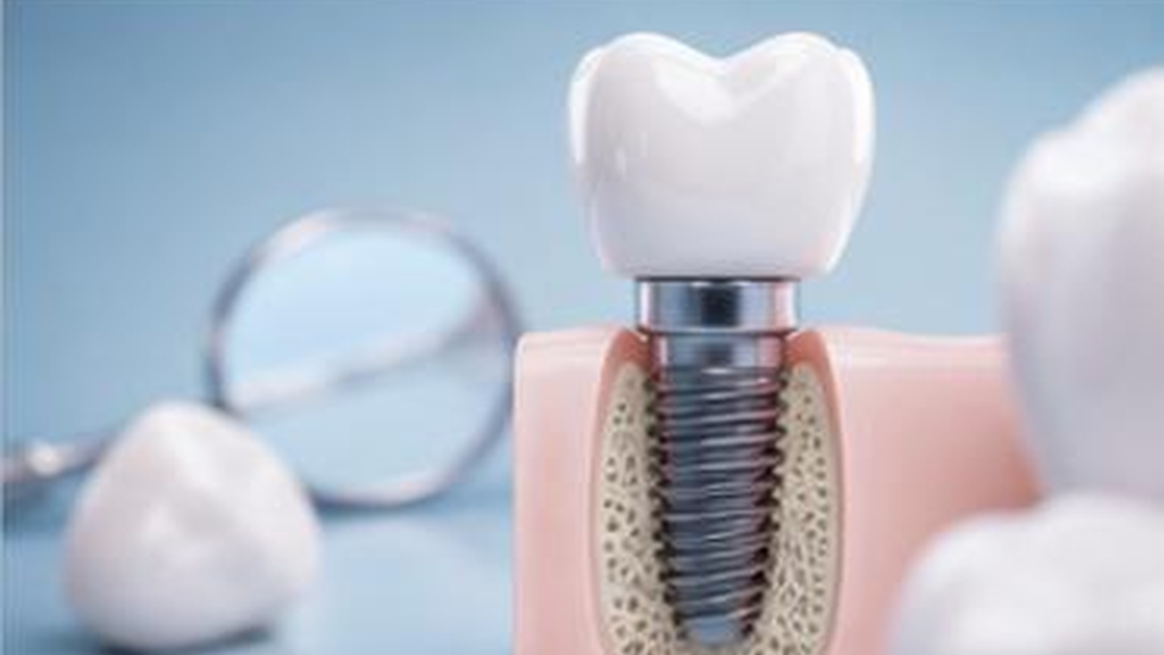 Bạn có biết 8 yếu tố thời gian ảnh hưởng đến cấy ghép implant khi nào khi chăm sóc răng