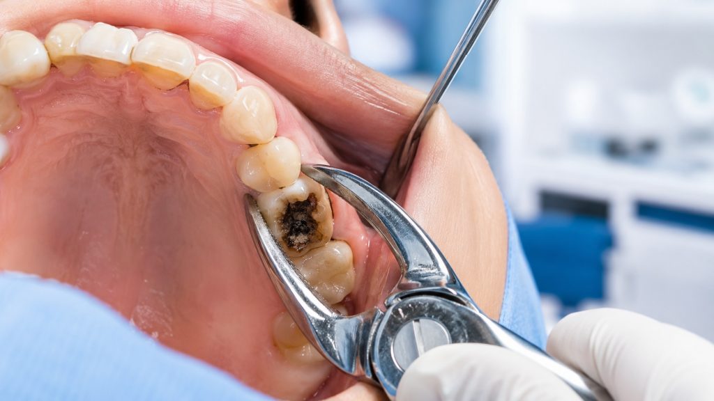Chuyên gia phân tích 7 dấu hiệu cảnh báo của nhổ răng sâu hàm trên theo nhu cầu riêng