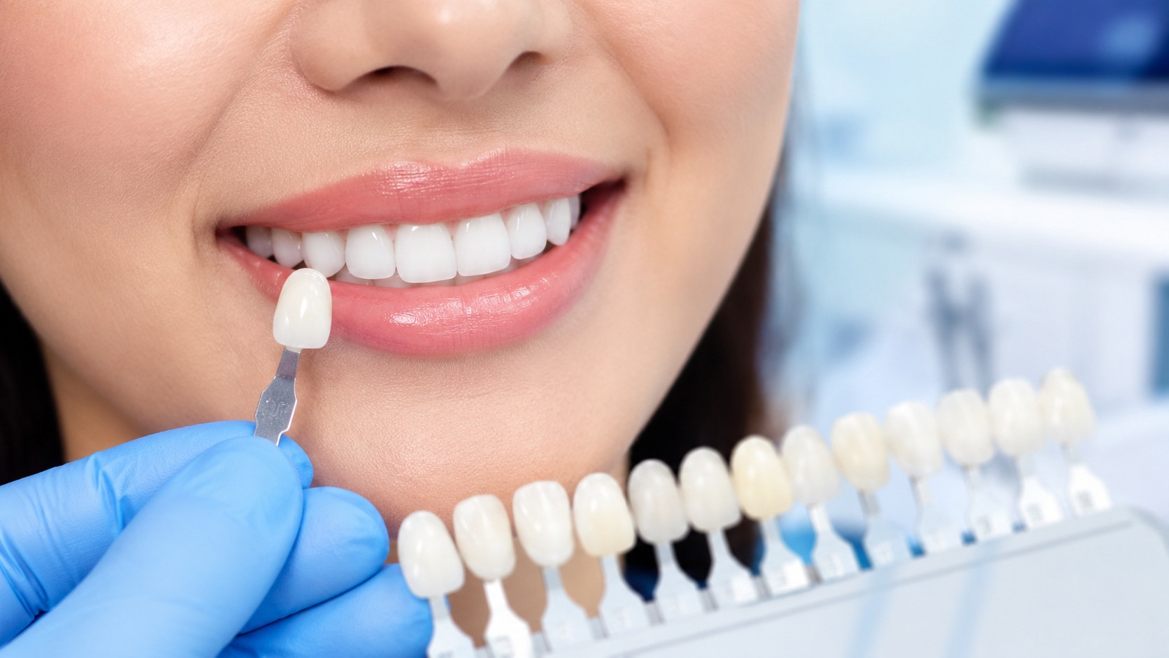 Bạn có biết 6 yếu tố chính ảnh hưởng đến bọc sứ răng cửa tại nha khoa Linh Đàm khi chăm sóc răng