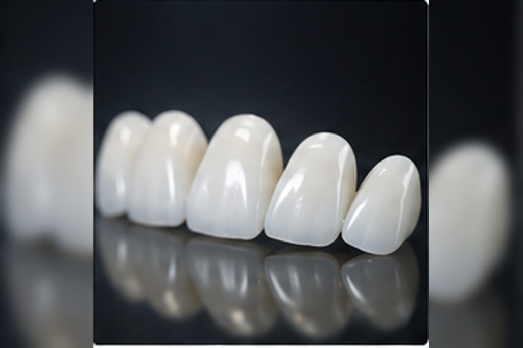 Sự thật về dán răng sứ thẩm mỹ qua 9 phân tích thực tế theo tư vấn chuyên môn