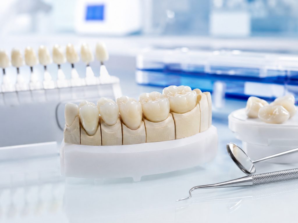 Bạn có biết 6 yếu tố chính ảnh hưởng đến chụp răng sứ cercon tại nha khoa Linh Đàm khi chăm sóc răng