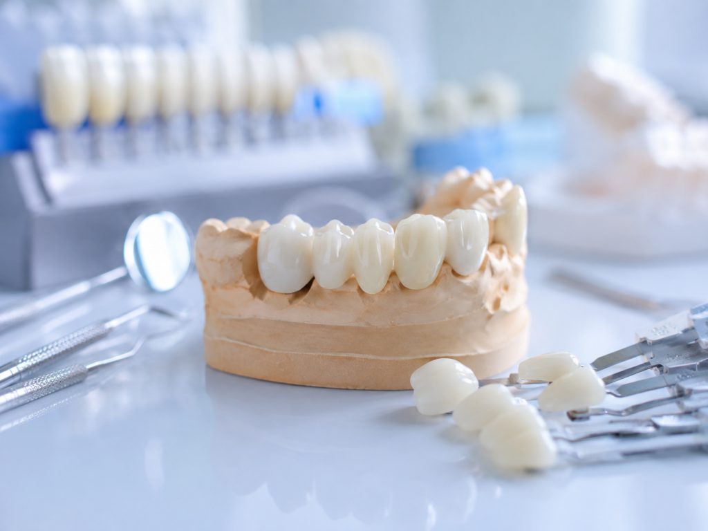 Giải đáp 4 thắc mắc phổ biến về cầu răng sứ đẹp cùng nha khoa Linh Đàm trước khi thực hiện